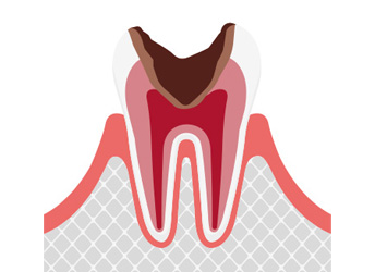 C3重度のむし歯