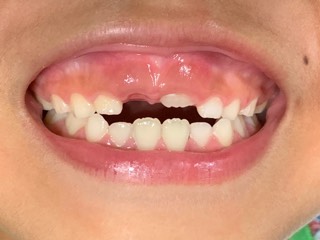 永久歯と乳歯✨