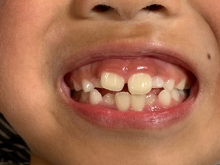 大人の歯と子供の歯✨