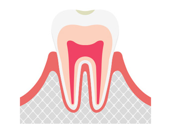 C0（シーゼロ）むし歯の前兆