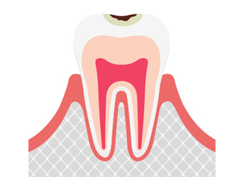 C1軽度のむし歯