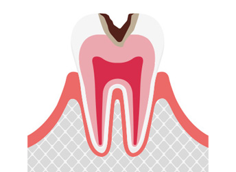 C2中度のむし歯