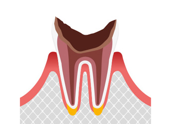 C4最重度のむし歯