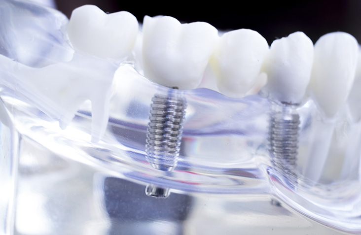 インプラント治療について