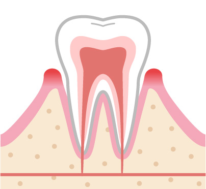 軽度歯周病