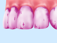 プラーク(歯垢)の染め出し